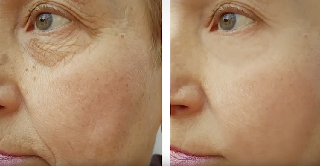 Preenchimento Facial